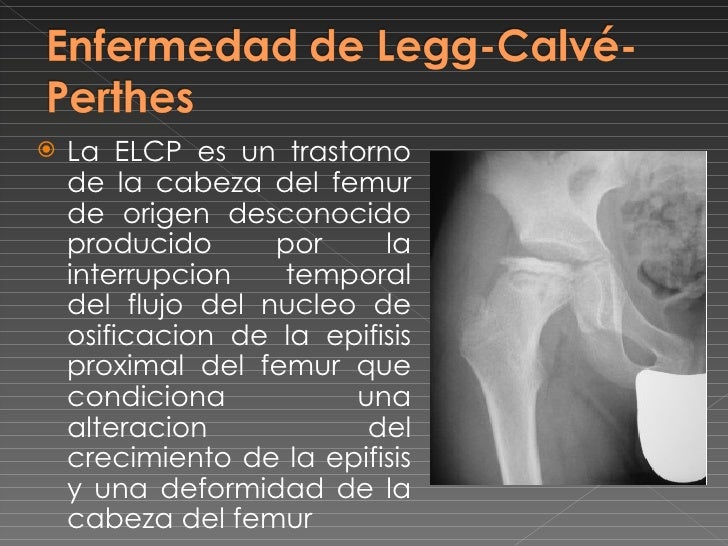 enfermedad de perthes pediatria